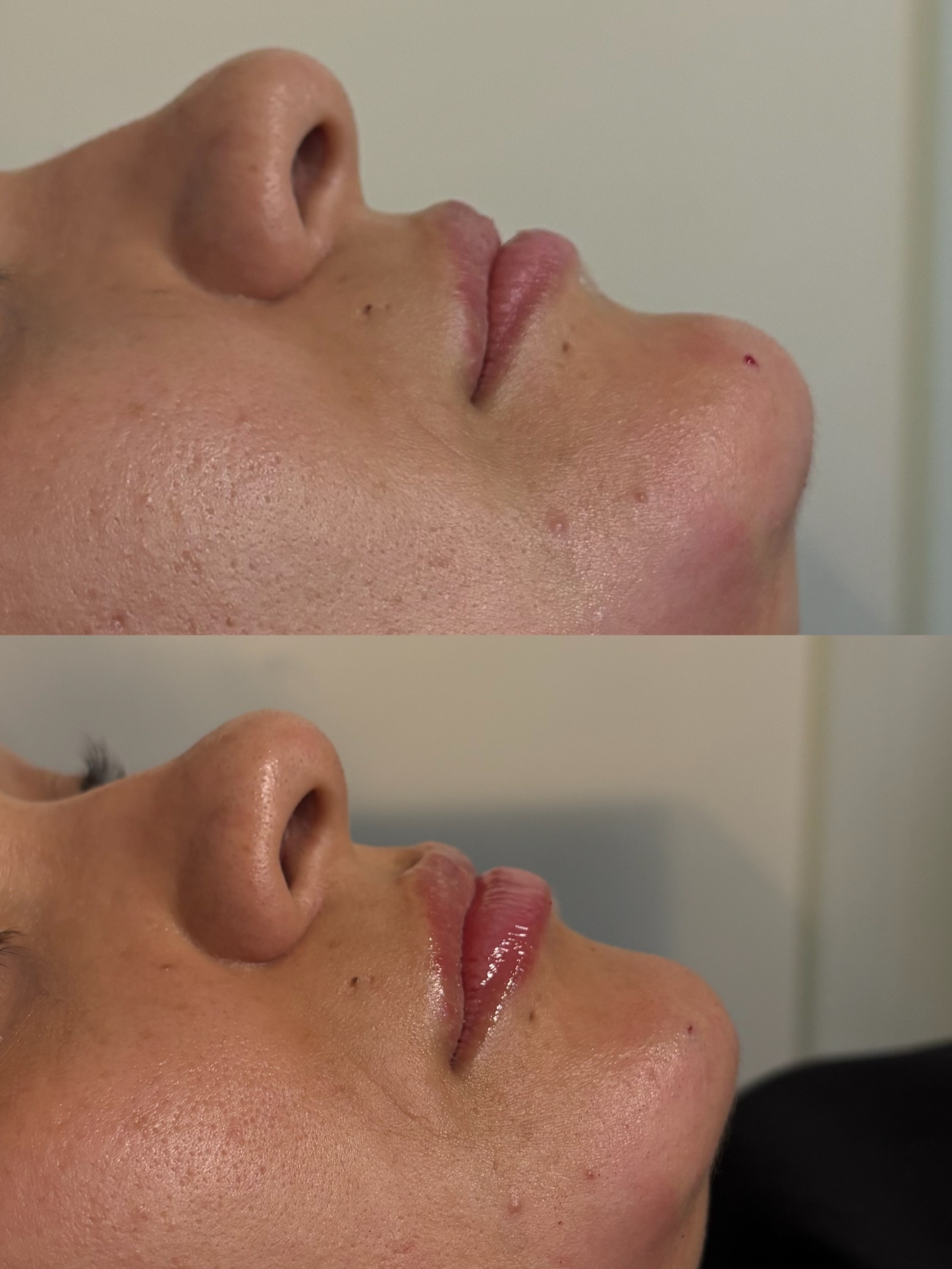 Antes e depois real de preenchimento labial