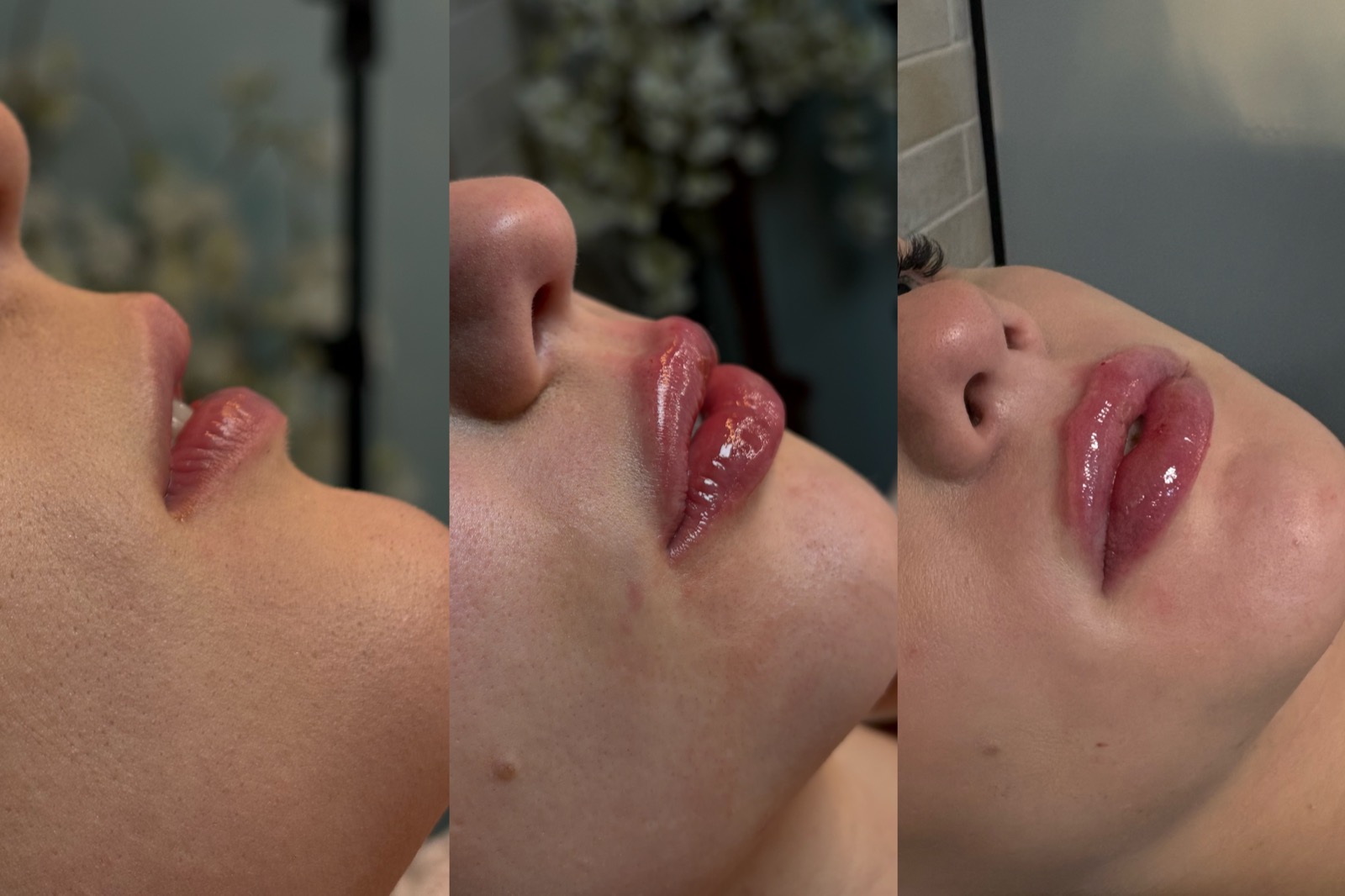 Antes e depois real de preenchimento labial