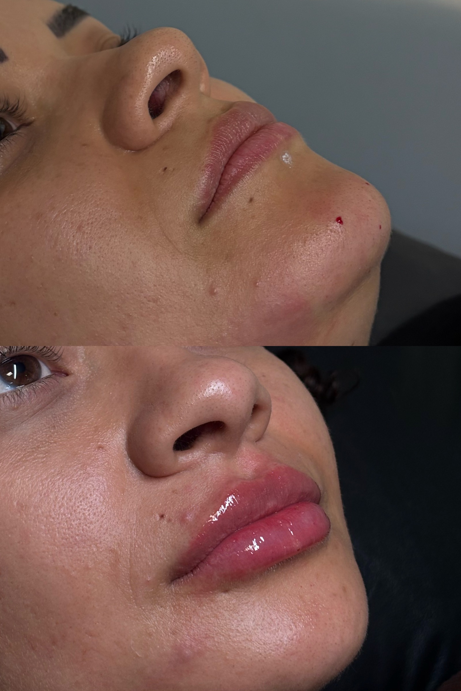 Antes e depois real de preenchimento labial