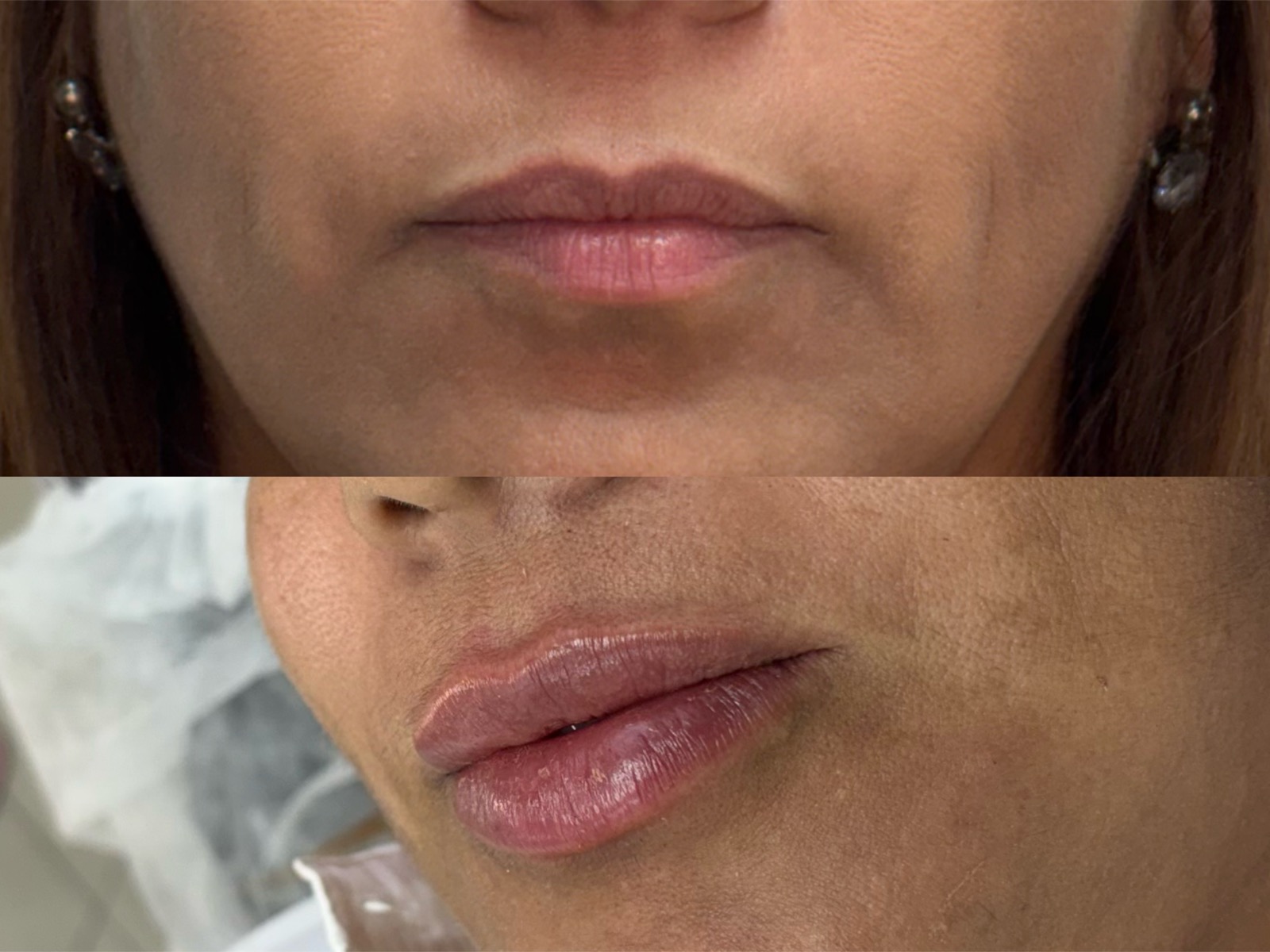 Antes e depois real de preenchimento labial