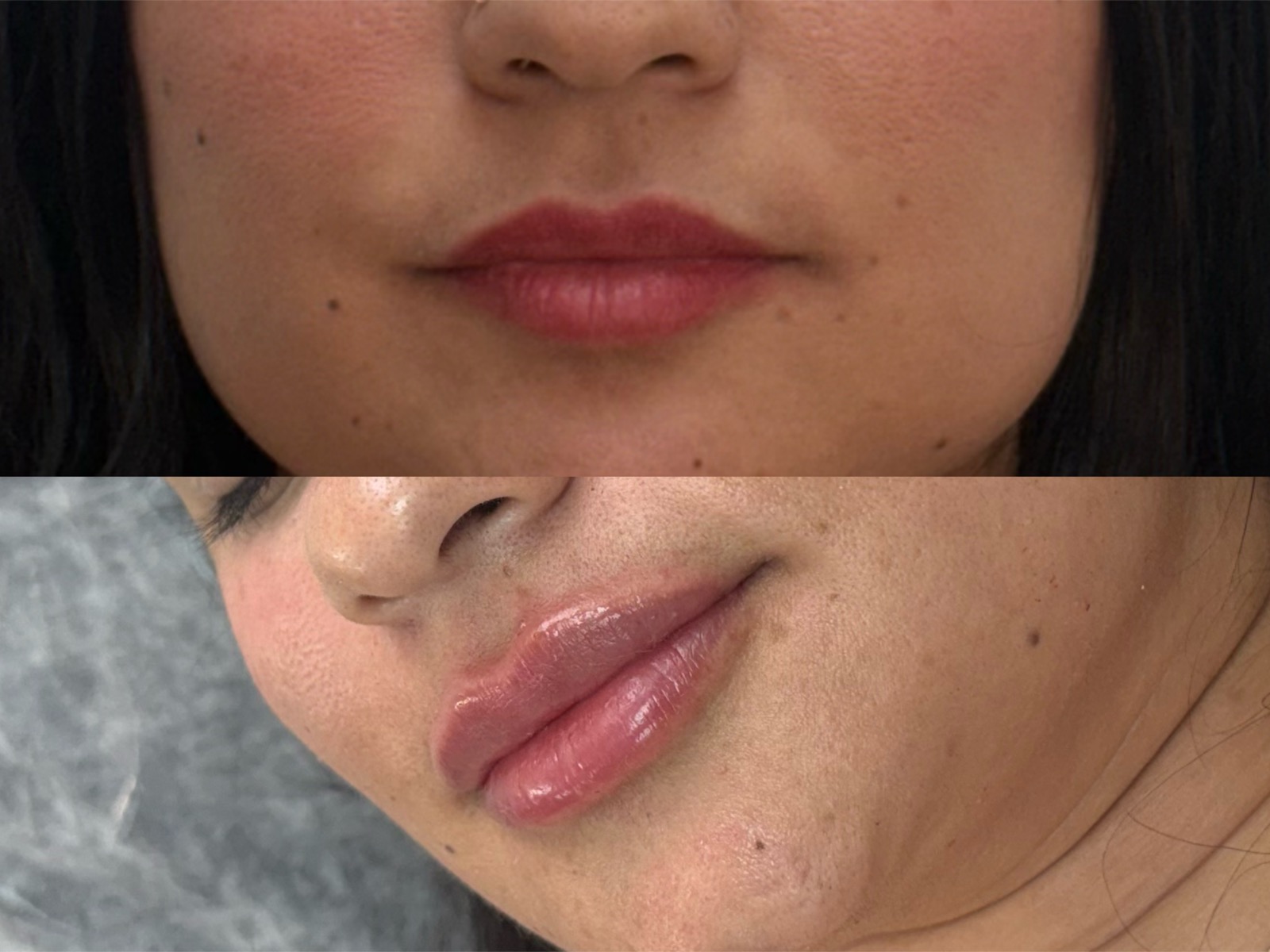 Antes e depois real de preenchimento labial