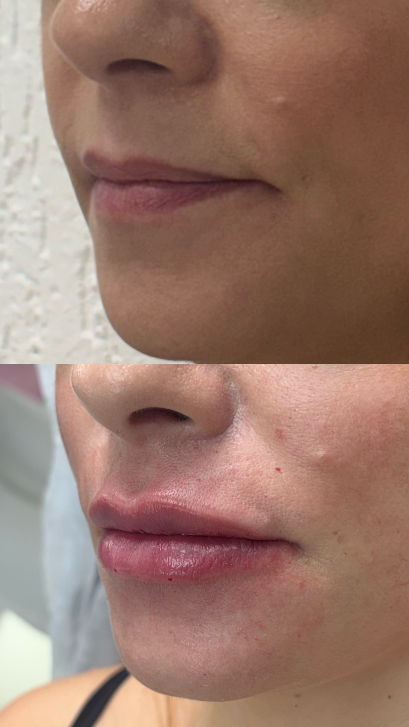 Antes e depois real de preenchimento labial