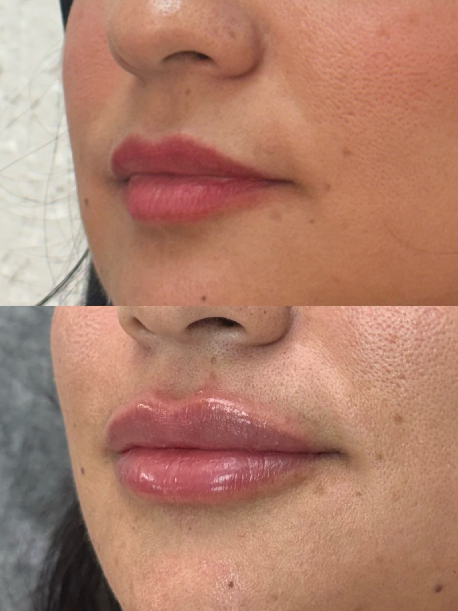 Antes e depois real de preenchimento labial