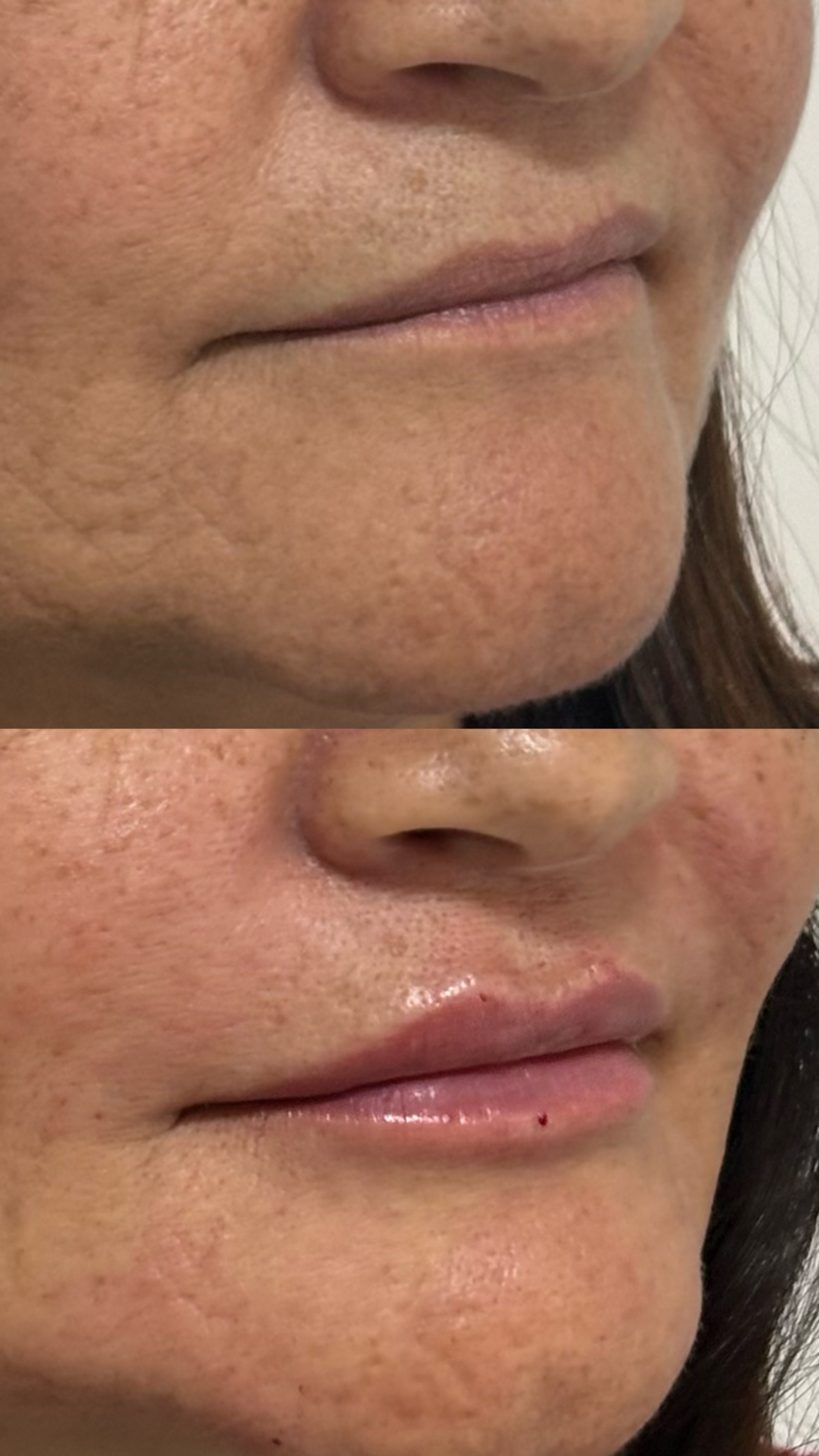Antes e depois real de preenchimento labial