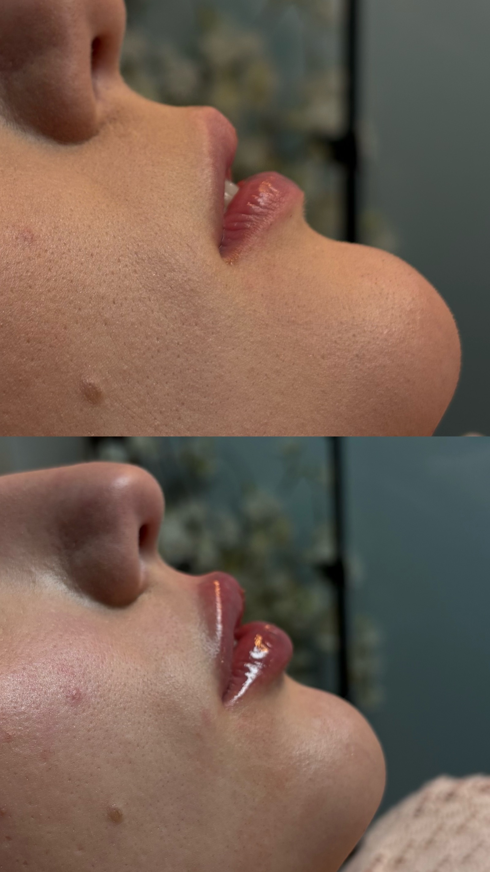 Antes e depois real de preenchimento labial