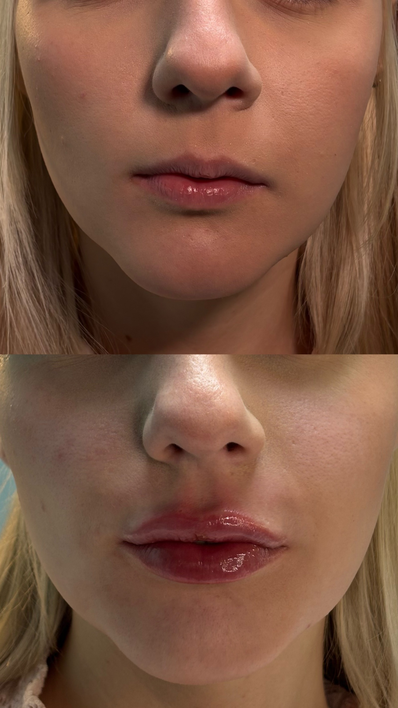 Antes e depois real de preenchimento labial