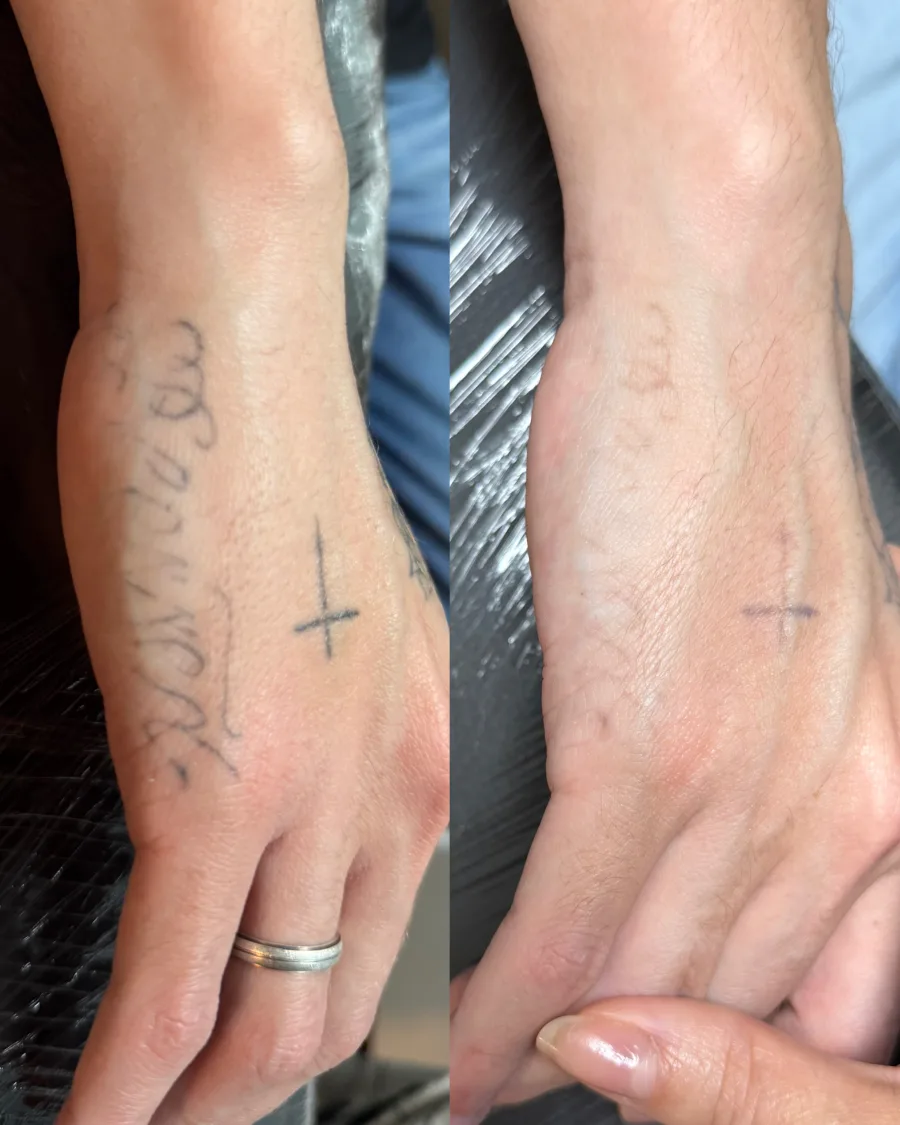 Remoção de tatuagem a laser — resultado