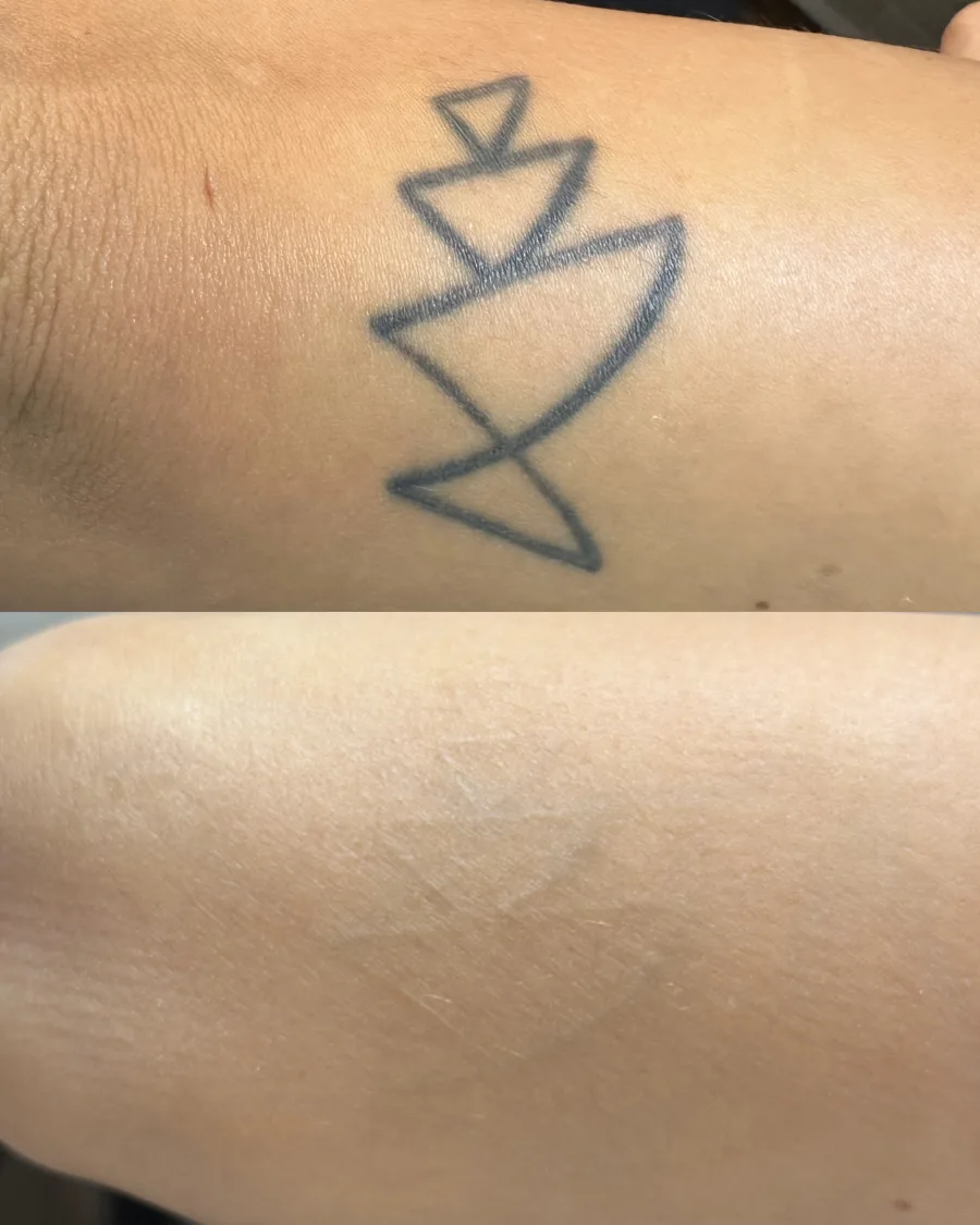 Remoção de tatuagem a laser — resultado
