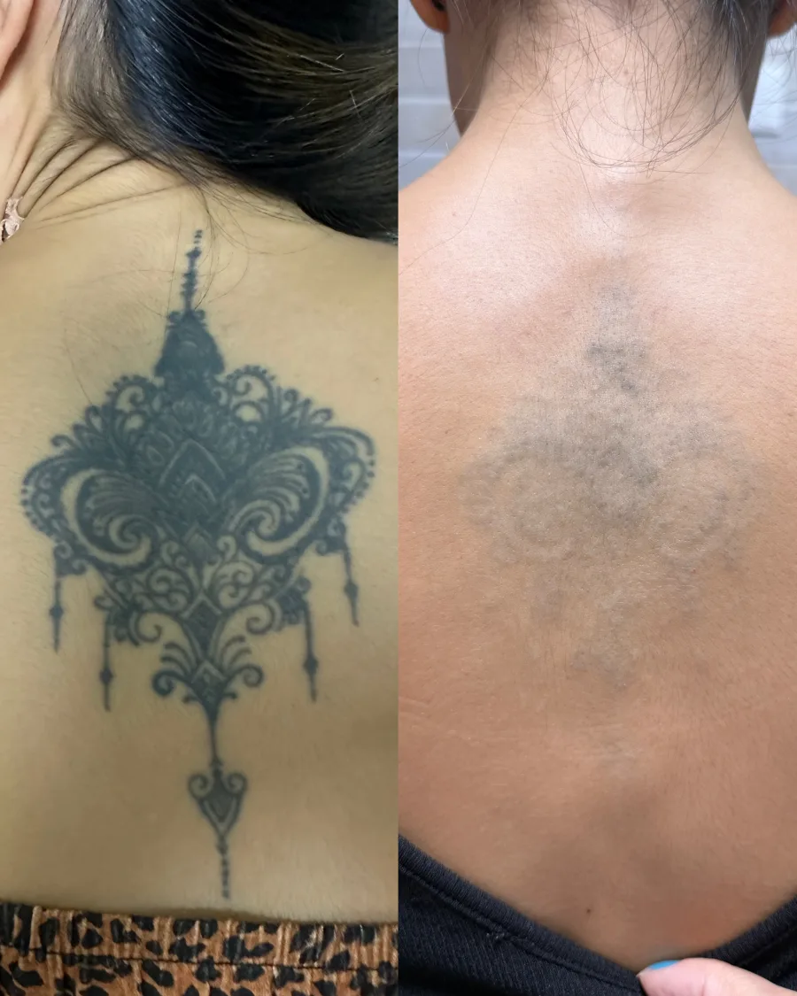 Remoção de tatuagem a laser — resultado