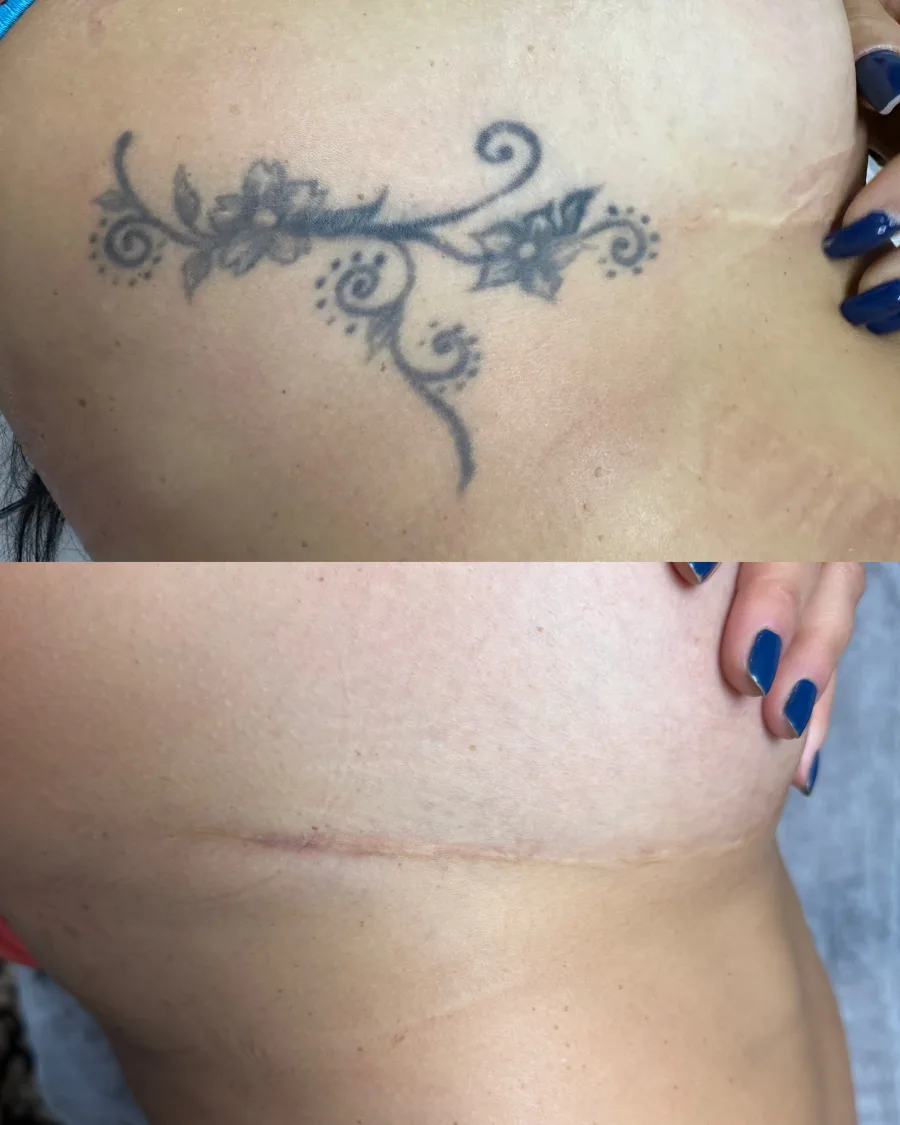 Remoção de tatuagem a laser — resultado
