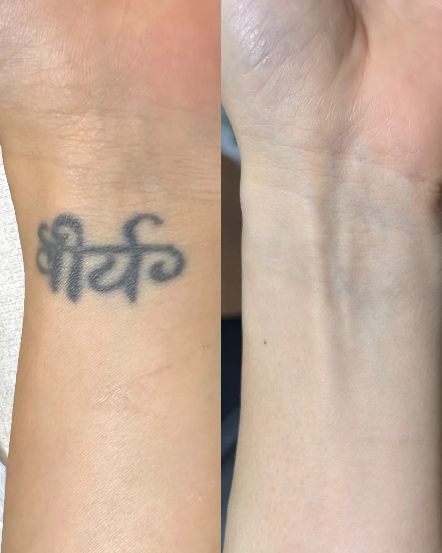 Remoção de tatuagem a laser — resultado
